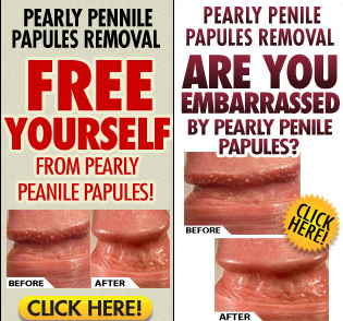 pearly-penile-papules-banner combined.